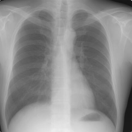 Chest X-ray converted from DICOM to JPG